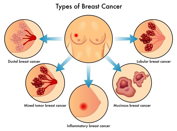 Which treatments are used for breast cancer?