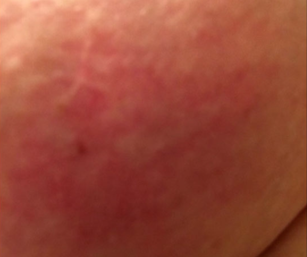 Why You Should Never Ignore a Red Patch on Your Chest ...