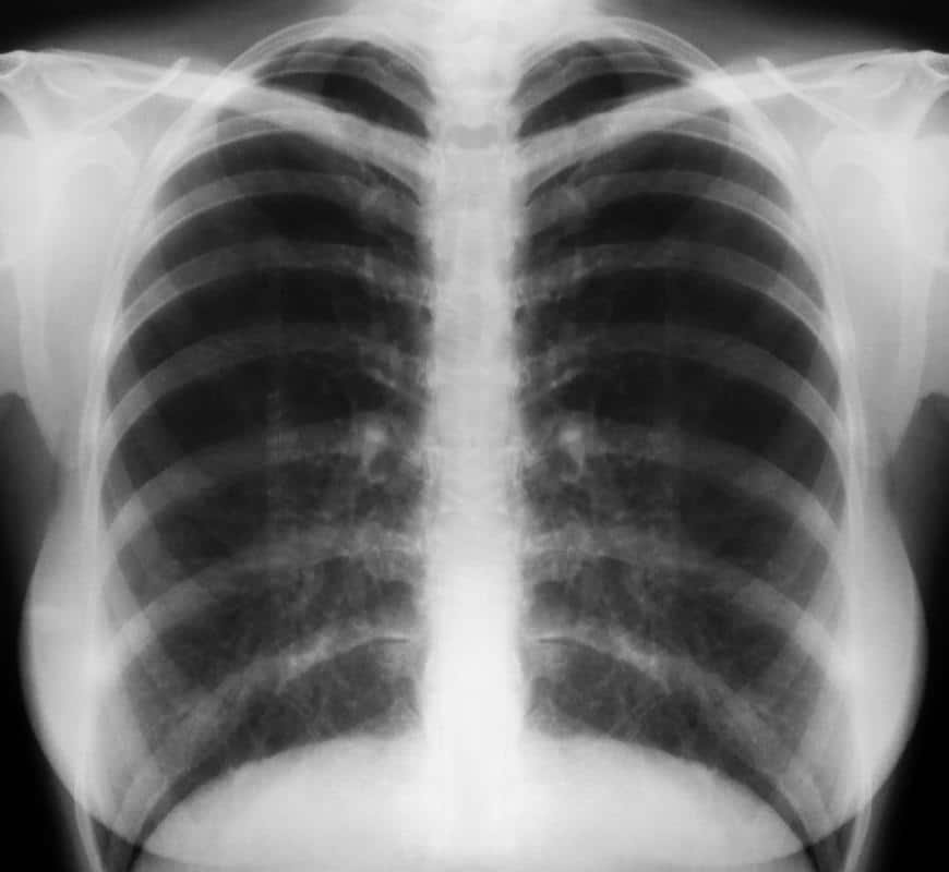 Would a chest xray show breast cancer ï¸?Updated