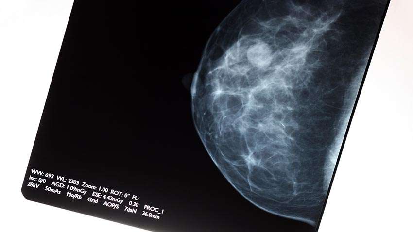 Yearly Mammograms Linked to Less Advanced Breast Cancer